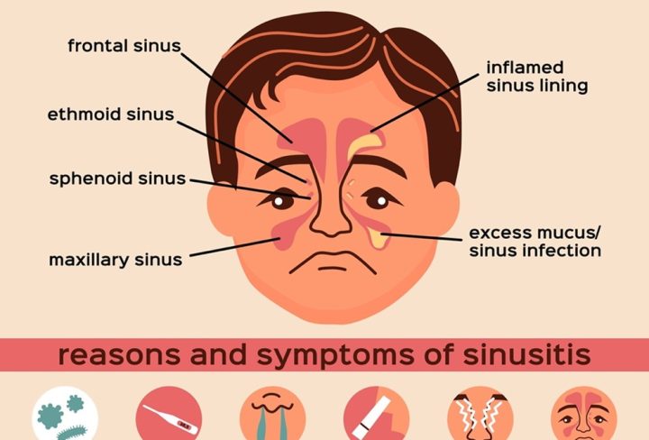 A Comprehensive Guide To Understanding Sinusitis Dr Salma ENT